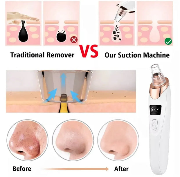 5-in-1 Blackhead remover, blackhead remover machine